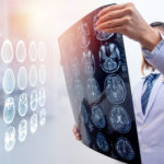 Mozgova prihoda diagnostika